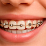 metallicheskie-brekety