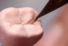 Коронка на зуб: когда нужна и как выбрать — помощь стоматологов